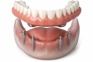 Comfortable Implant-Supported Dentures in Spring TX