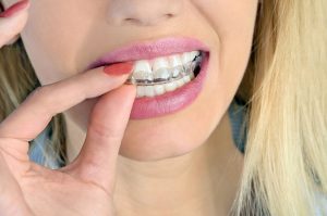 Things to Remember When Wearing Dental Braces - Vistadent