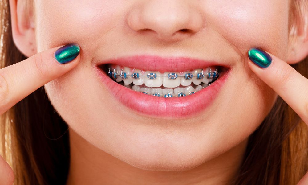 9 Benefits of Wearing Braces for Teenagers