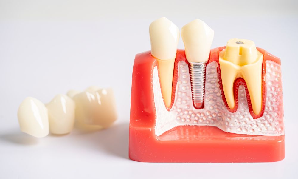 Do You Need a Bone Graft for Dental Implants?