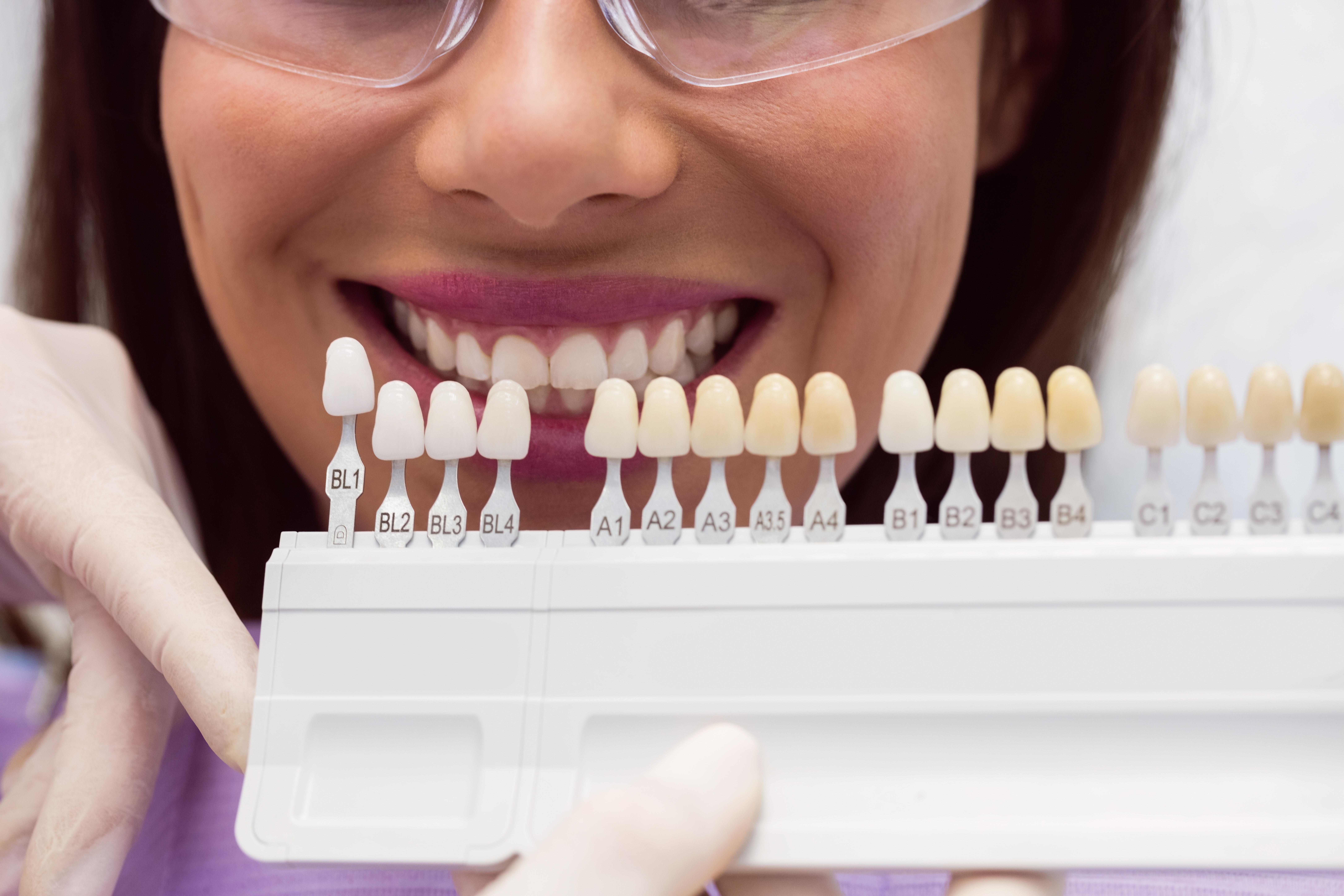 How to Pick the Best Shade for Veneers and Crowns