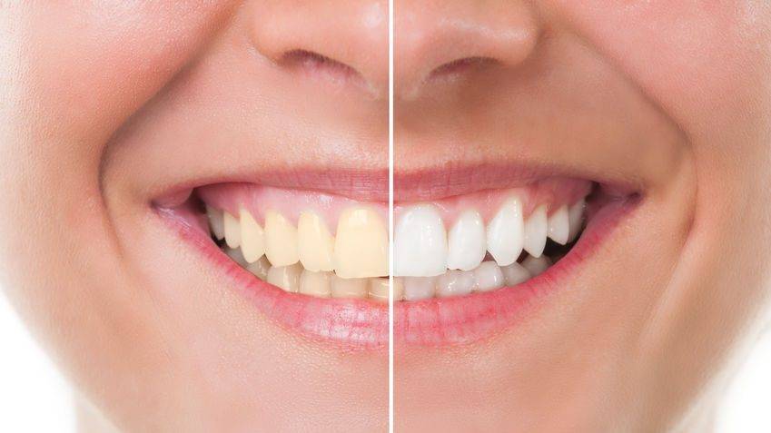 teeth cleaning Magnolia, TX