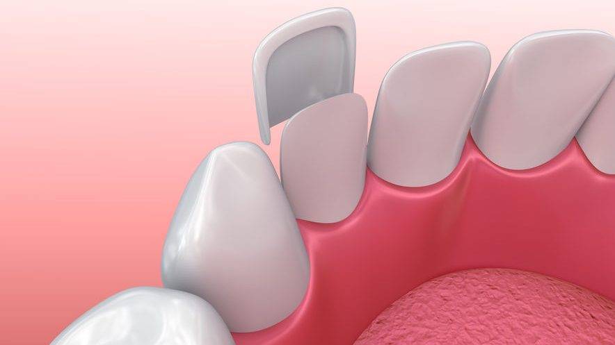 dental implant near me Spring, TX