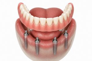 Implant-Supported Dentures in Spring TX for secure smiles